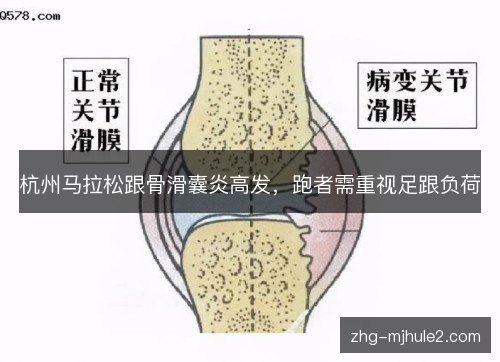 杭州马拉松跟骨滑囊炎高发，跑者需重视足跟负荷